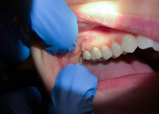 Best Dental Abscess Treatment in Crown Pot, IN