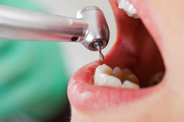 Best Lost Filling or Crown Replacement in Crown Pot, IN